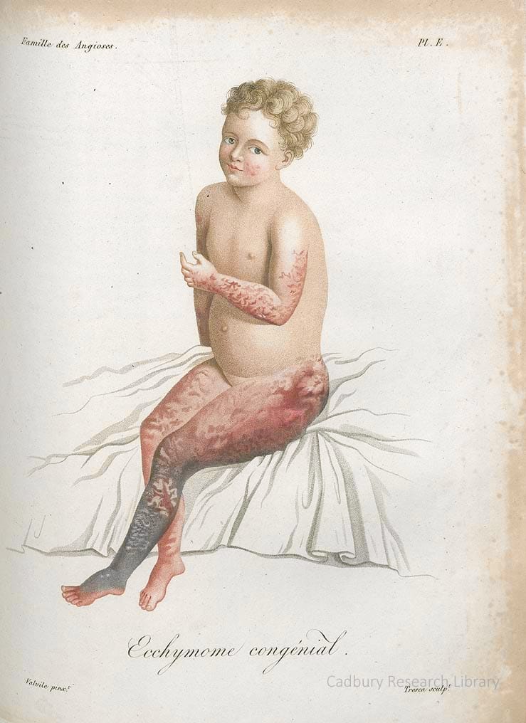 Ecchymome congenial, from Jean-Louis Alibert's 'Nosologie Naturelle' (1806)