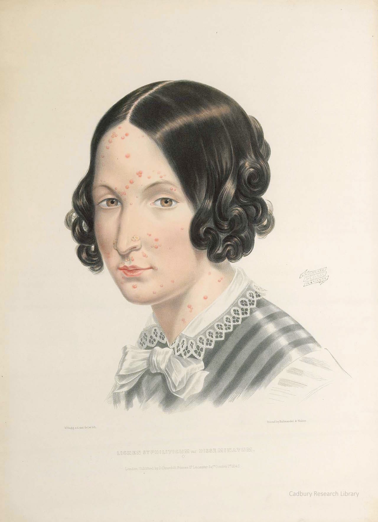 Lichen, Portraits of Diseases of the Skin, Sir Erasmus Wilson Cadbury Research Library