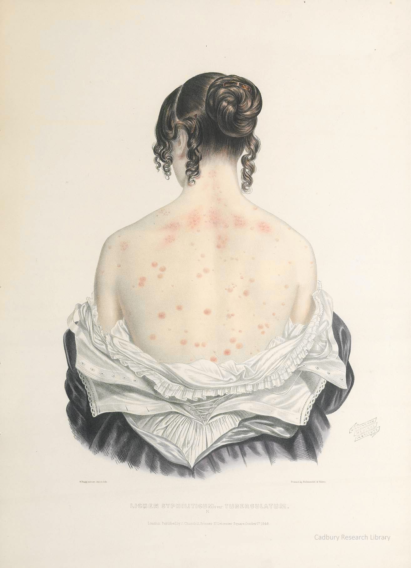 Lichen Syphiliticum, Portraits of Diseases of the Skin, Sir Erasmus Wilson Cadbury Research Library