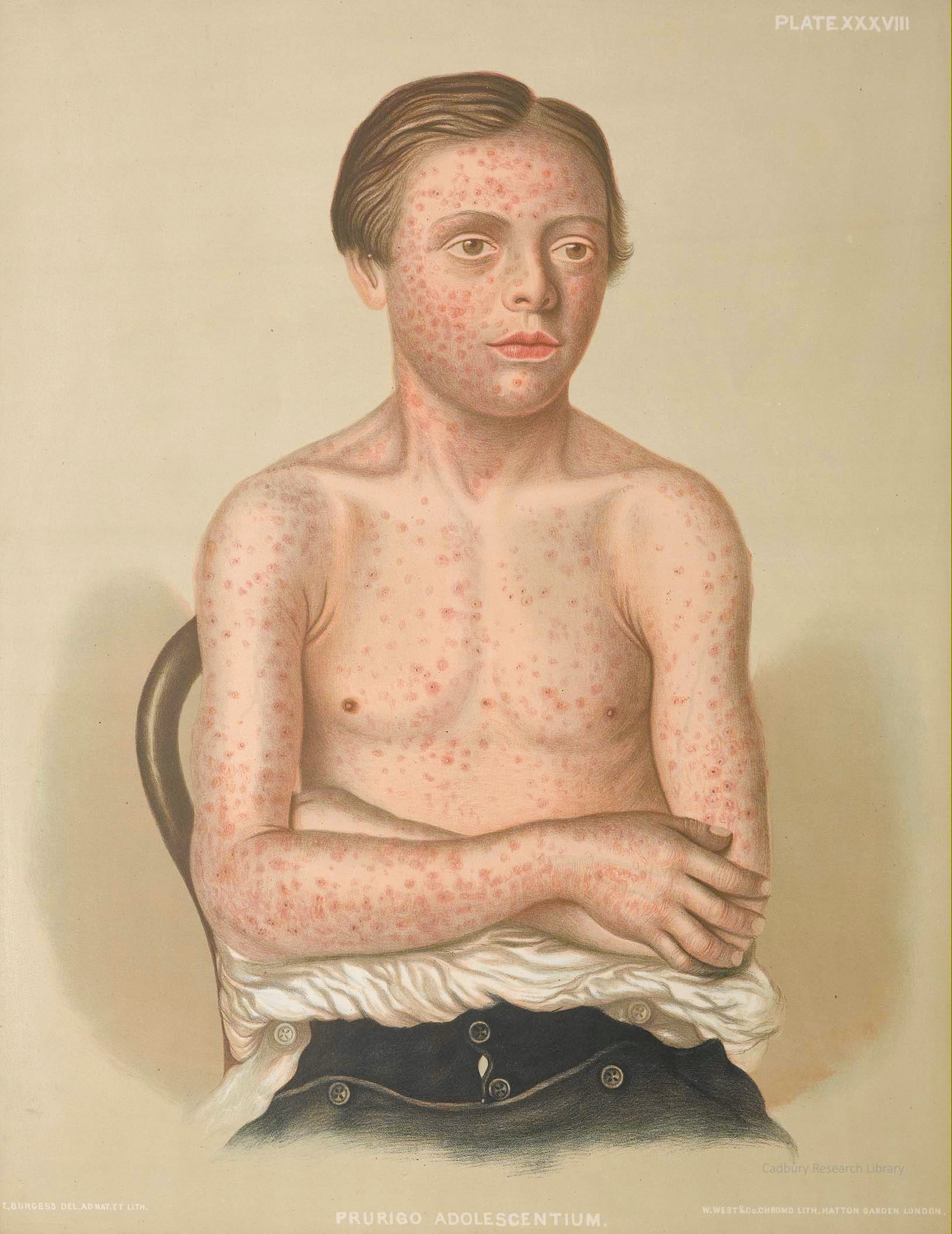 Prurigo Adolescentium, Atlas of Portraits of Diseases of the Skin, New Sydenham Society, Vol LX, 1873 Cadbury Research Library