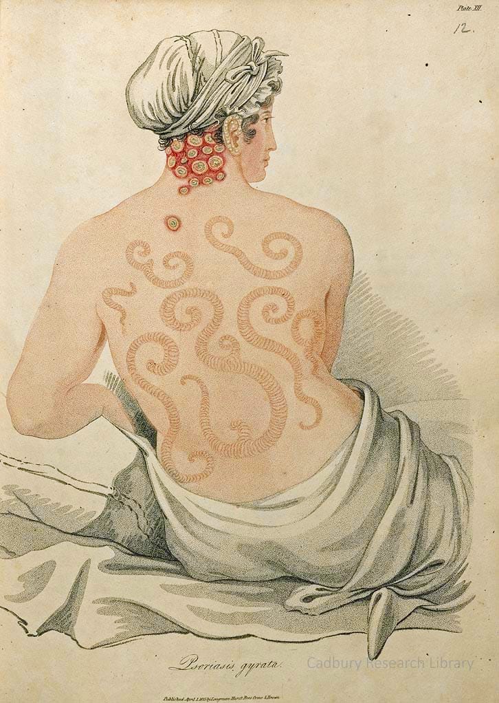 Psoriosis gyrata, Delineations of Cutaneous Diseases, Bateman 1828 Cadbury Research Library