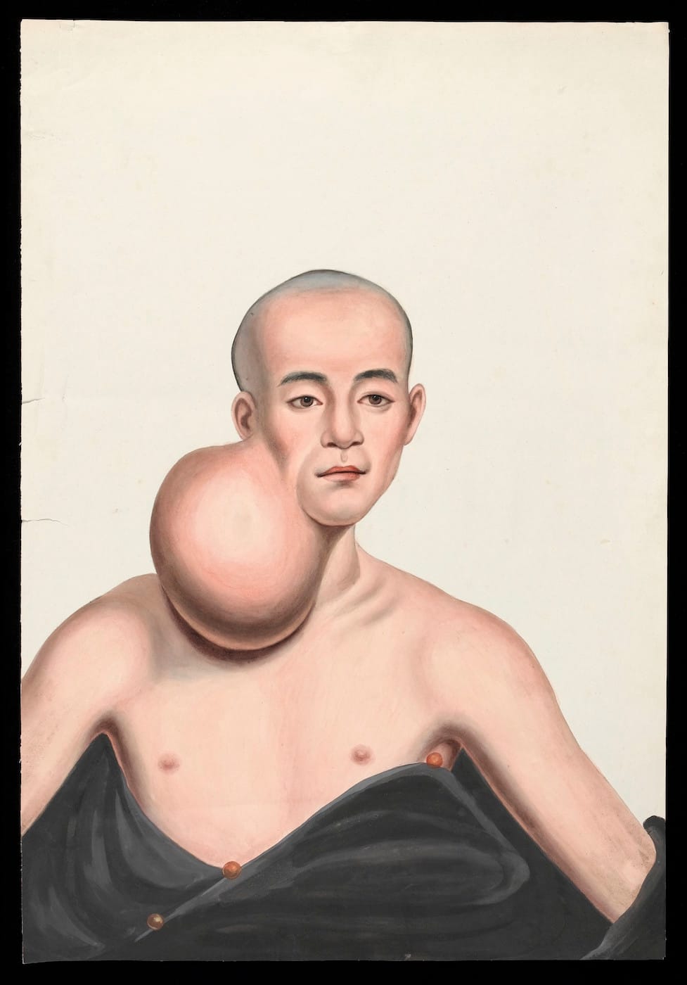 Guan Qiaochang Lamqua, "A man (Choo Yihleang), facing front, with a massive spherical tumour on the right side of his neck" (via Wellcome Images/Wikimedia)