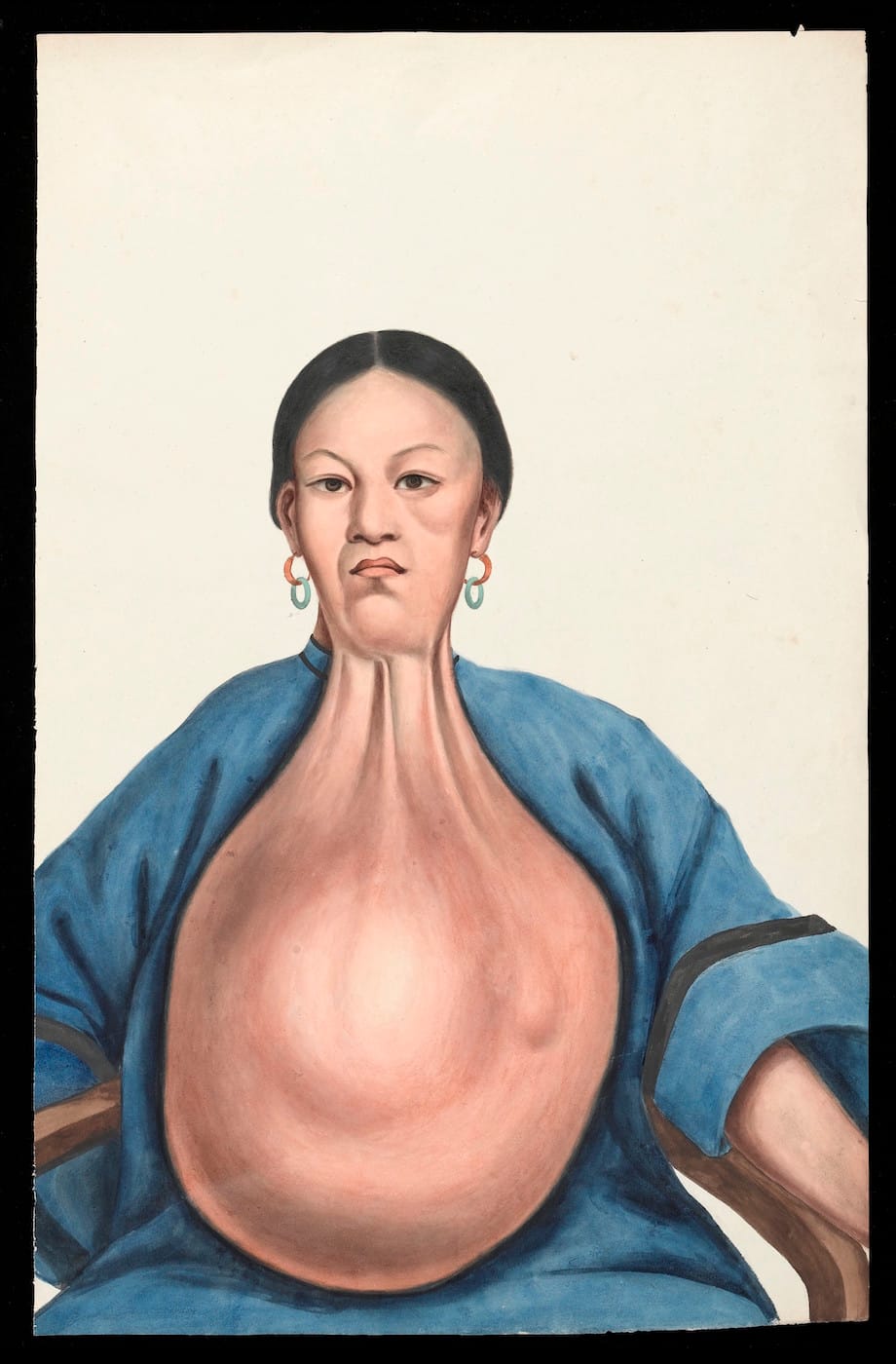 Guan Qiaochang Lamqua, "A woman, Yang She, facing front, with a massive pendent tumour hanging down from her neck" (via Wellcome Images/Wikimedia)