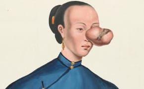 An Unlikely East-West Collaboration in 1830s Portraits of Tumor Patients