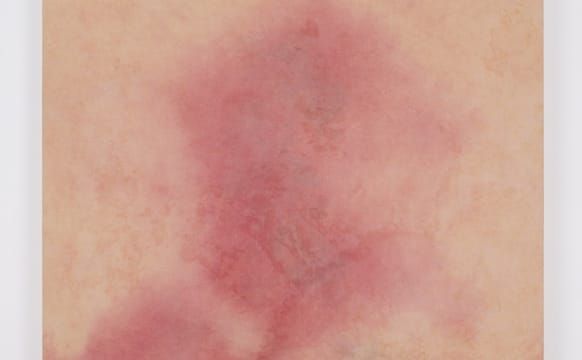 Painting the Violent Life Cycles of Bruises