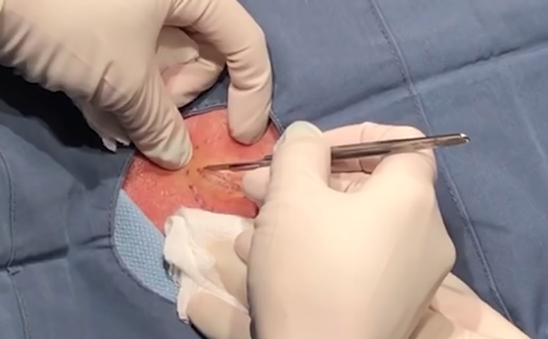 Why Pimple Popping Videos Are So Strangely Satisfying