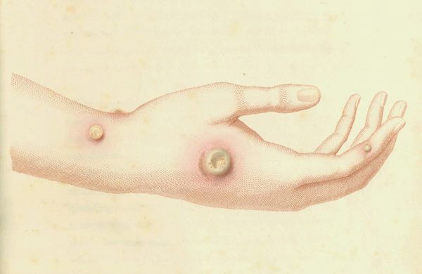 Fascinating Illustrations of 18th-century Inoculations by the Inventor of the Smallpox Vaccine
