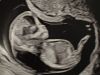 An ultrasound image of Jennifer Adkins’ 12-week-old fetus that was diagnosed with Turner syndrome and hydrops fetalis, two