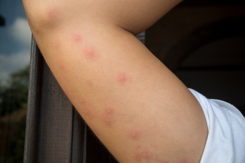 how to recognize bedbug bites