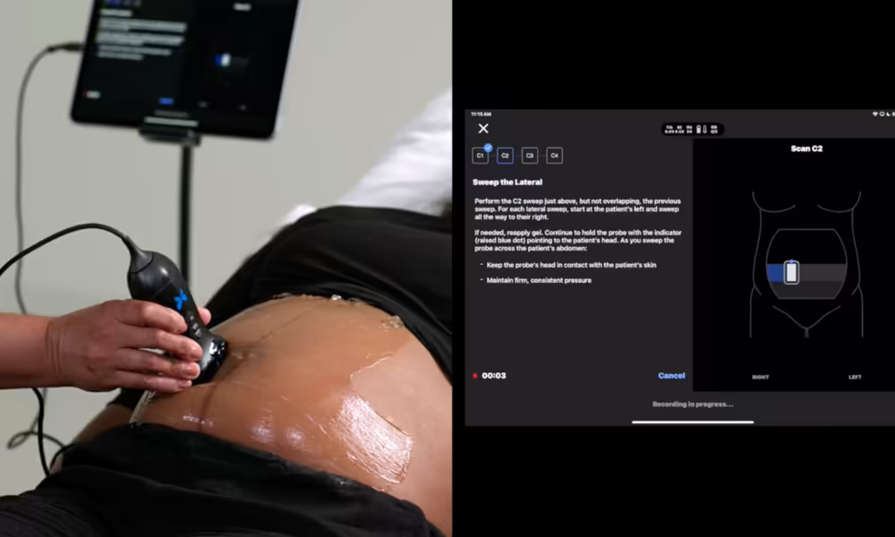 Butterfly Network handheld ultrasound gestational age AI tool press image