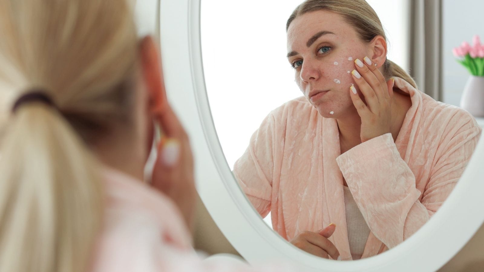 Acne, lang na je sweet sixteen, kan één van de symptomen van PCOS zijn.
