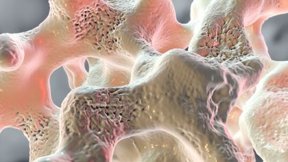 Alles wat je moet weten over osteoporose