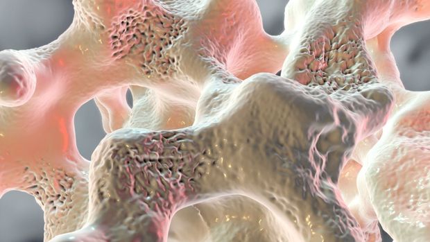 Alles wat je moet weten over osteoporose