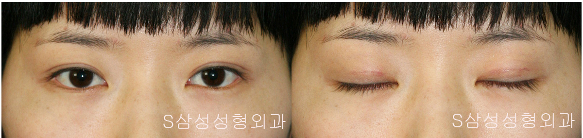 [대구쌍수] 자연스러운 쌍꺼풀이 되기 위한 5가지 조건