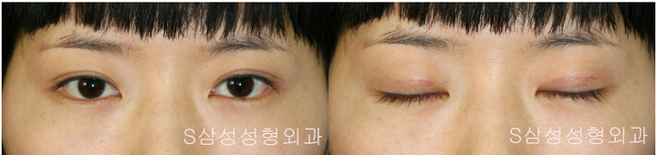 대구쌍수, 자연스러운 쌍꺼풀