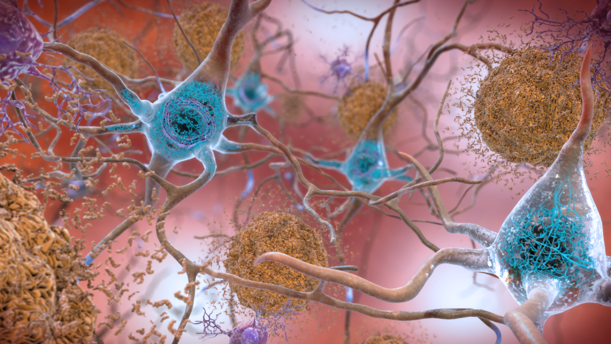 Ilustrație a neuronilor afectați de boala Alzheimer, cu plăci de amiloid și ghemuri de tau