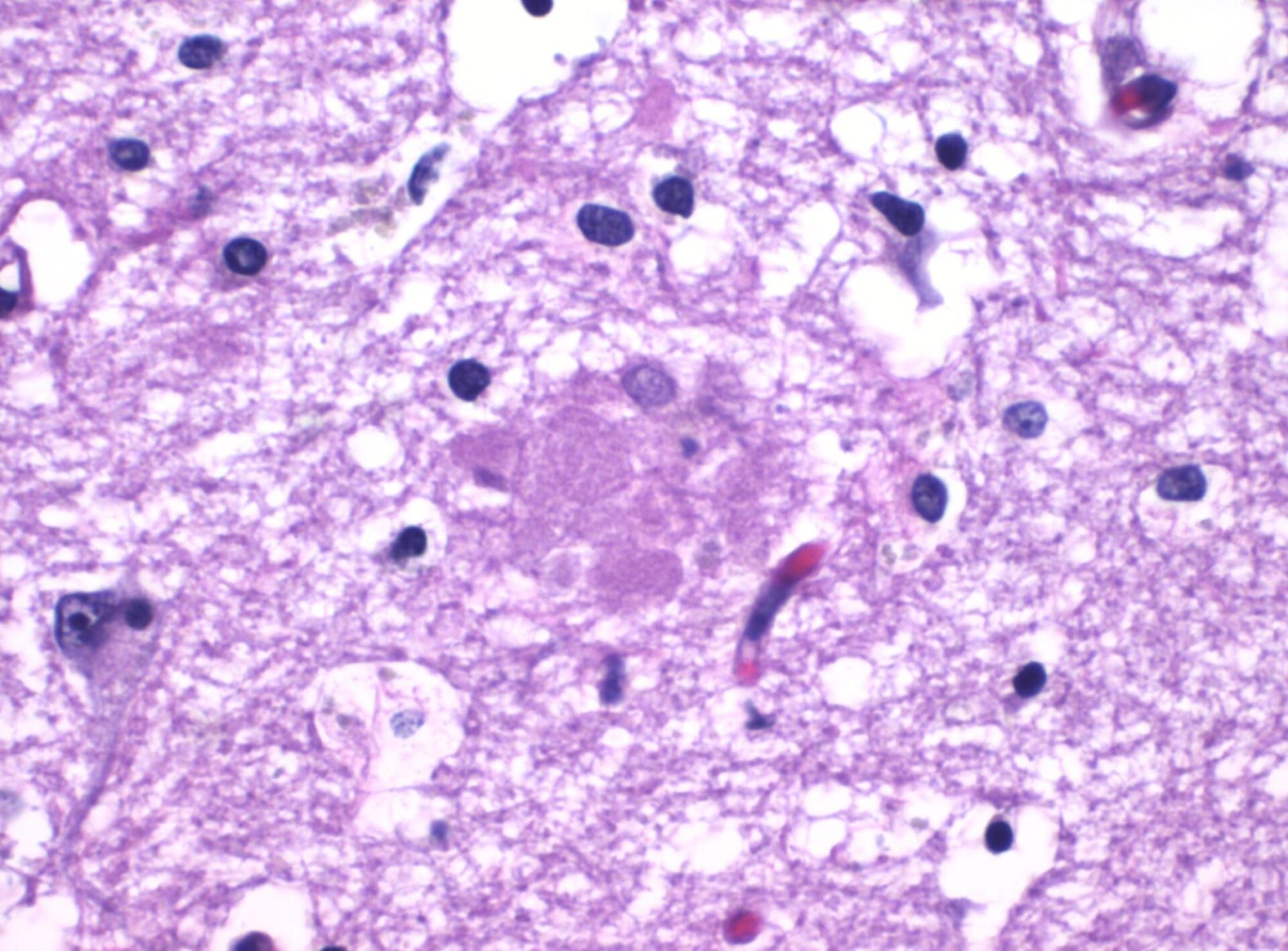Micrografie a unei plăci de amiloid în boala Alzheimer