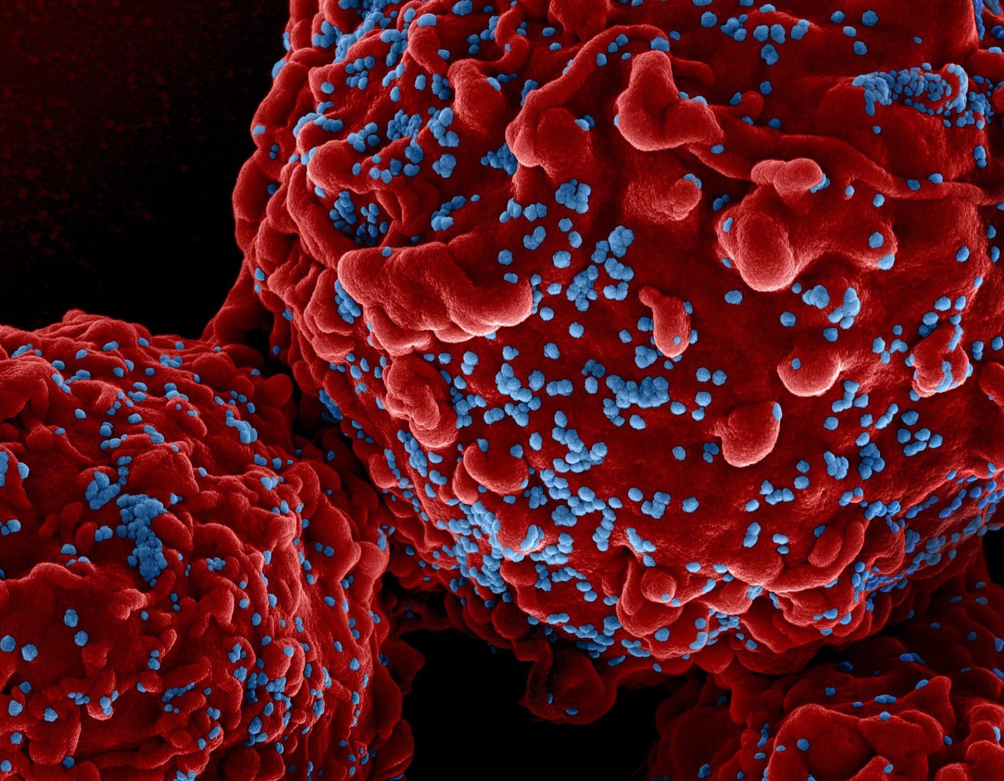 Imagine de microscopie electronică colorată a particulelor de virus HIV