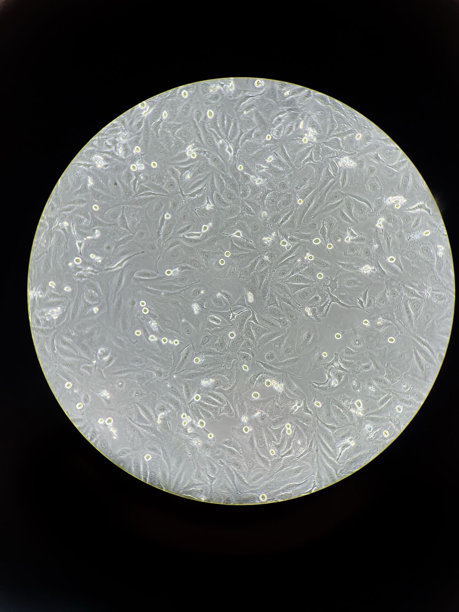 Celule canceroase văzute la microscop, într-o cultură de laborator