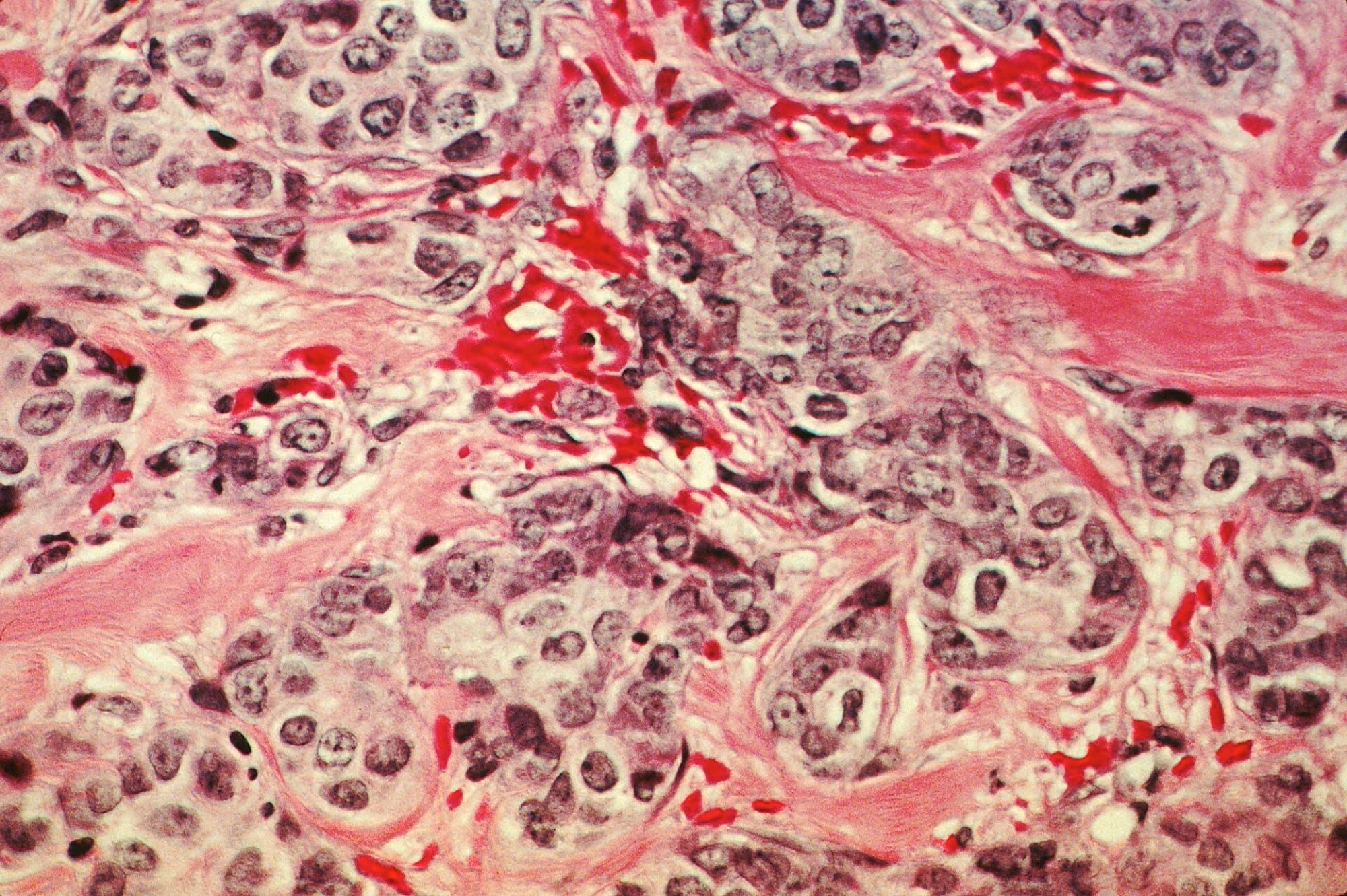Micrografie microscopică a unor celule de cancer mamar