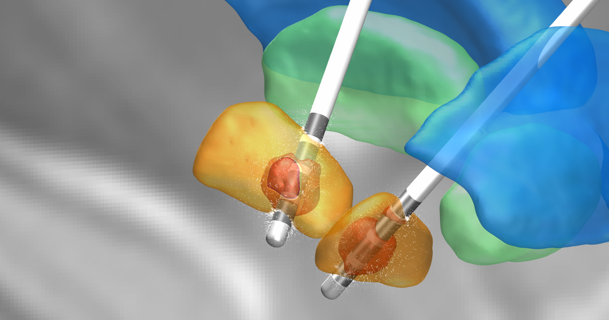 Randare 3D a electrozilor de stimulare cerebrală profundă implantați în nucleul subtalamic