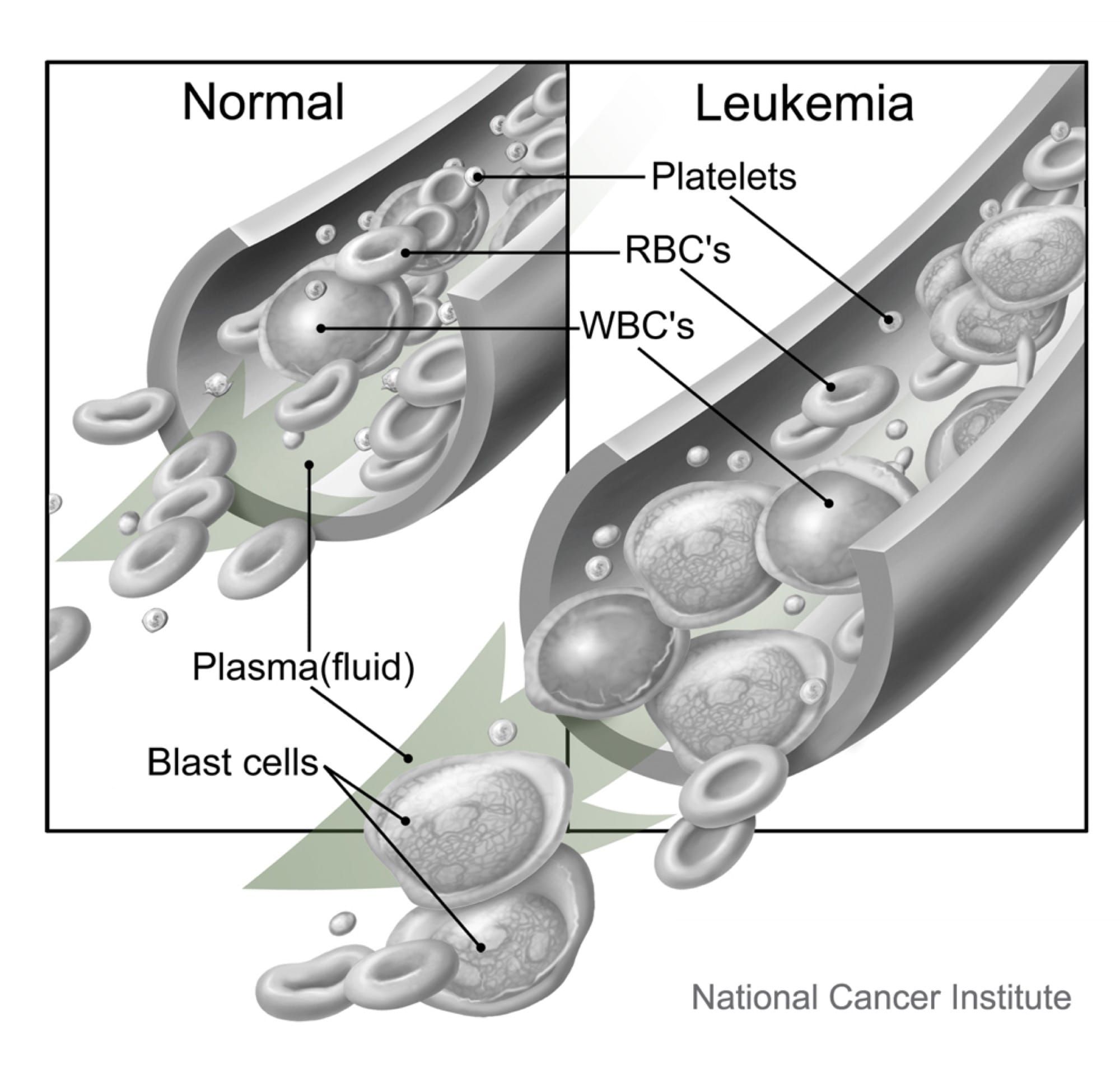 Ilustrație medicală comparând celule sangvine normale cu celule de leucemie