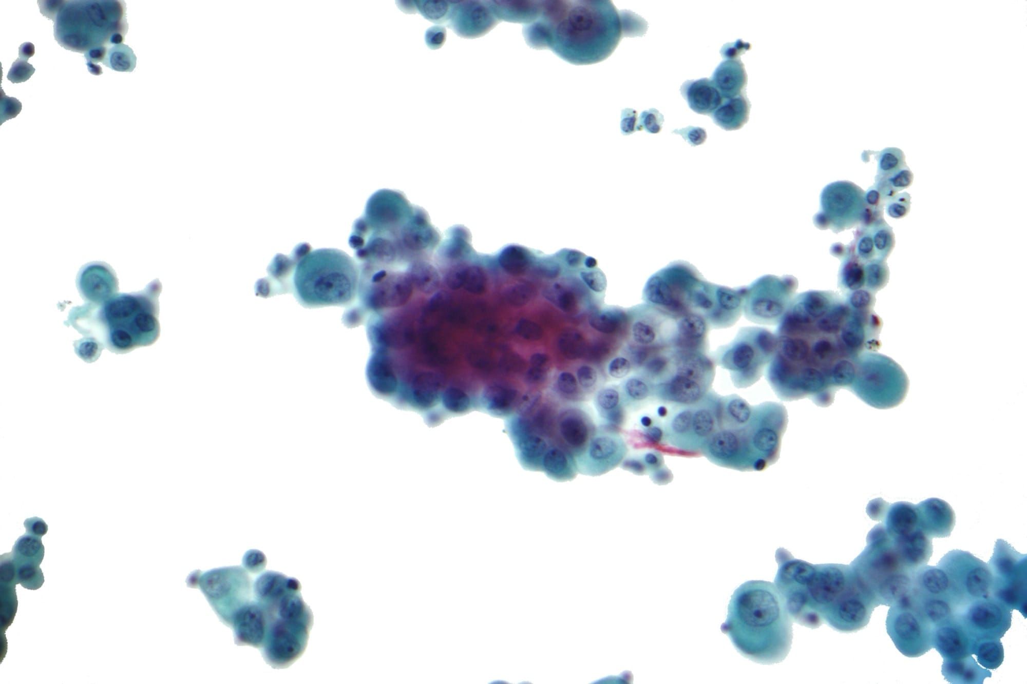 Celule de mezoteliom vazute la microscop, colorate pentru citologie