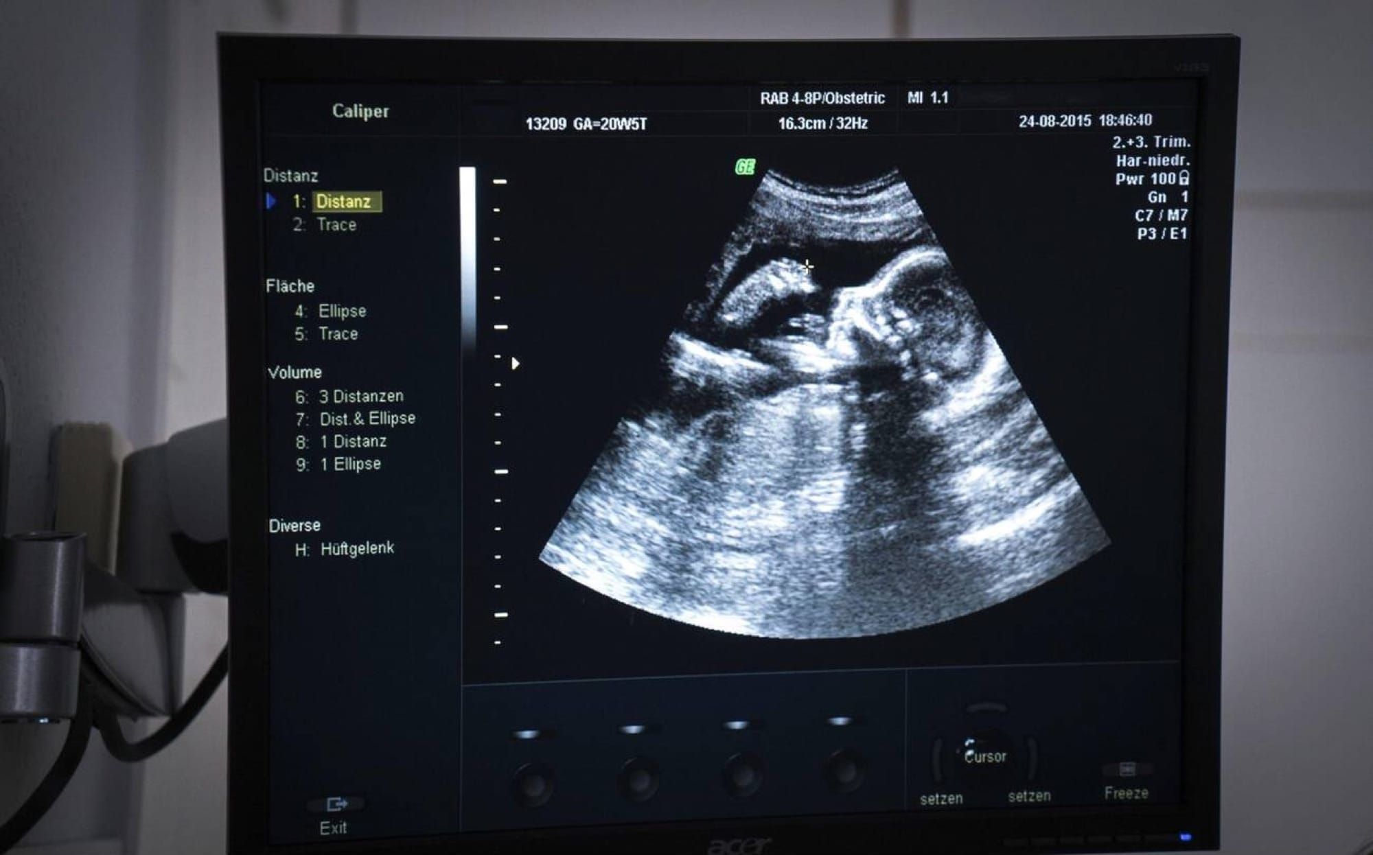 Monitor de ecografie obstetricală, arătând un făt în timpul unei examinări