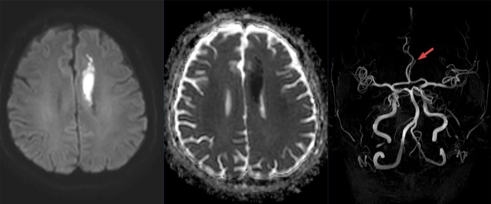 Scanări RMN ale unui infarct cerebral, cu zona afectată vizibilă