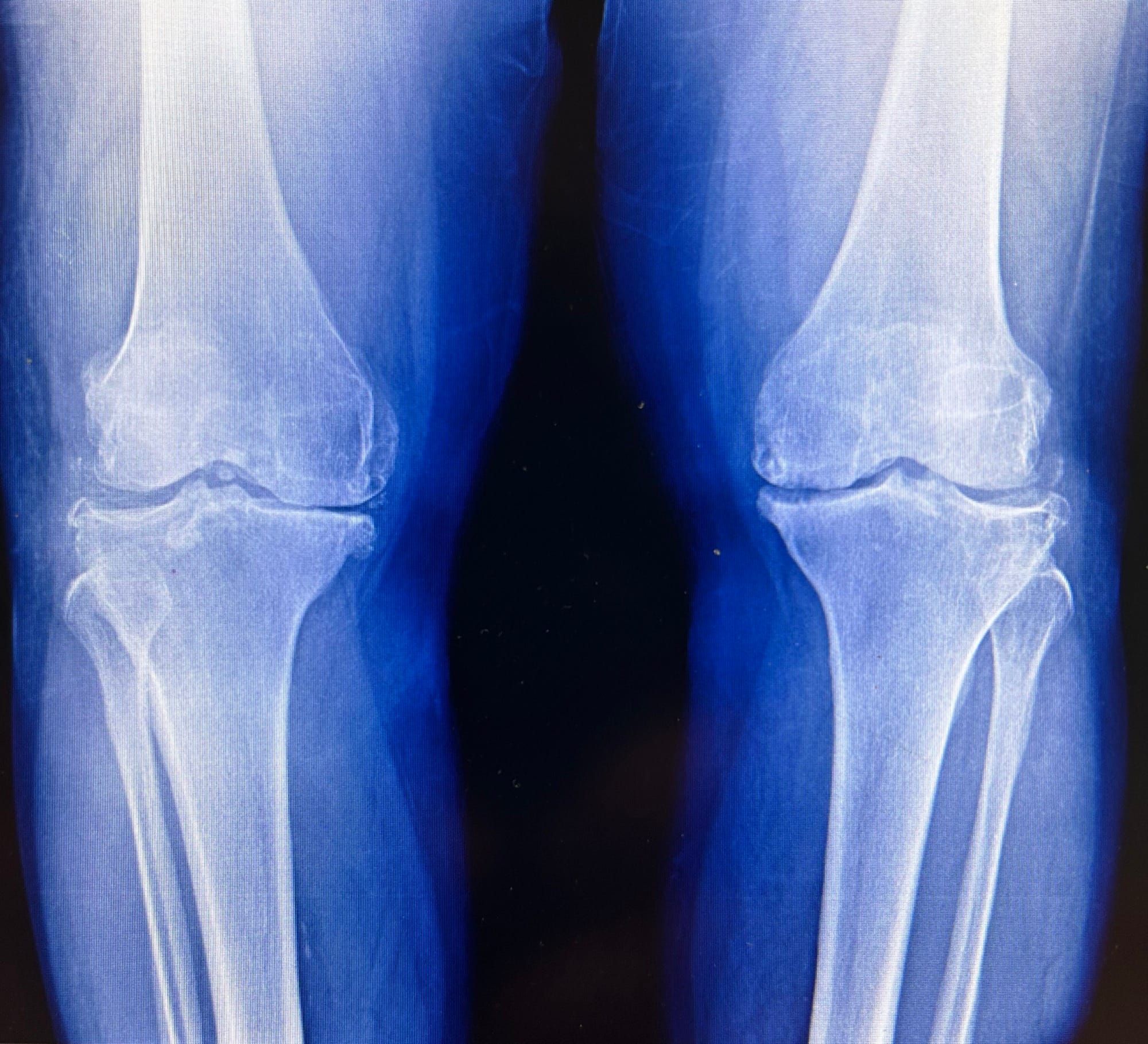 Radiografie a ambilor genunchi cu semne de artroză