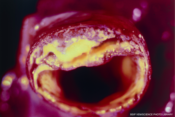 Role of antibodies in atherosclerosis