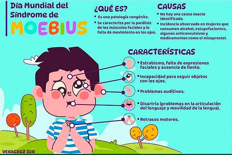 ¡DÍA MUNDIAL DEL SÍNDROME DE MOEBIUS! -PATOLOGÍA CARACTERIZADA POR UNA PARÁLISIS DE LOS MÚSCULOS FACIALES Y FALTA DE MOVIMIENTO EN LOS OJOS...
