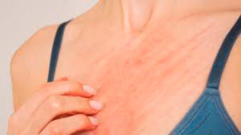 TIPS PARA MEJORAR LA CALIDAD DE VIDA | LA SARNA 2 - Continuamos con el tema de la sarna y te puedo decir que con el paso del tiempo, los surcos pueden resultar difíciles de ver, ya que quedan enmascarados por la inflamación...
