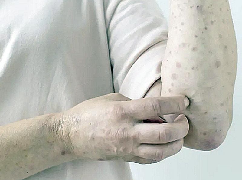 ¡PUEBLA ACUMULA 205 CASOS DE SARAMPIÓN EN 2026!