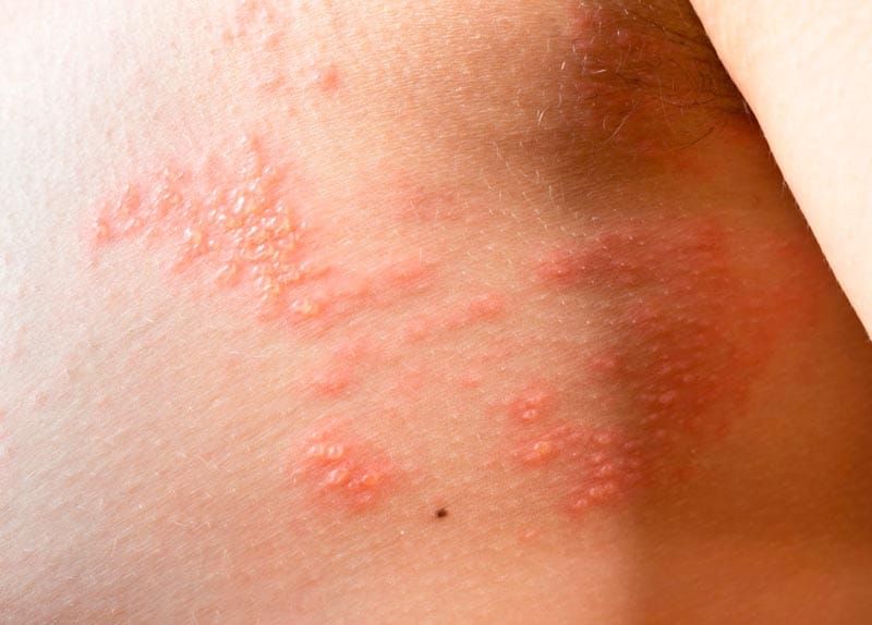 TIPS PARA MEJORAR TU CALIDAD DE VIDA | LA SARNA 1 - Una gran parte de los parásitos cutáneos son diminutos insectos o gusanos que se esconden dentro de la piel haciendo de ella su hábitat natural -Algunos de estos parásitos viven en la piel durante…