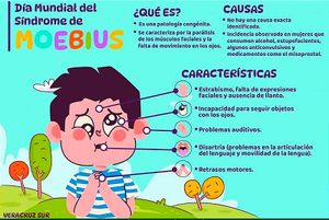 ¡DÍA MUNDIAL DEL SÍNDROME DE MOEBIUS! -PATOLOGÍA CARACTERIZADA POR UNA PARÁLISIS DE LOS MÚSCULOS FACIALES Y FALTA DE MOVIMIENTO EN LOS OJOS...