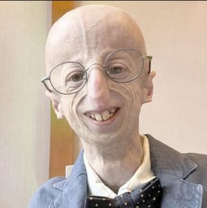 ¡MURIÓ SAMMY BASSO A LOS 28 AÑOS; PADECÍA SÍNDROME QUE ACELERA EL ENVEJECIMIENTO!