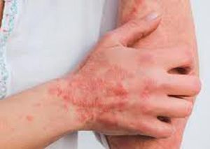 TIPS PARA MEJORAR LA CALIDAD DE VIDA | LA SARNA 1 - Una gran parte de los parásitos cutáneos son diminutos insectos o gusanos que se esconden dentro de la piel, haciendo de ella su hábitat natural. Algunos de estos parásitos viven...