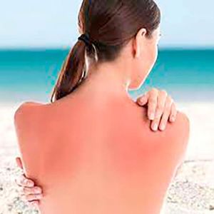 TIPS PARA MEJORAR LA CALIDAD DE VIDA | QUEMADURA DE SOL - Para aliviar el dolor, toma un analgésico de venta libre lo antes posible, después de haber estado expuesto al sol demasiado tiempo...