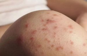 ¡ALERTAN POR SARAMPIÓN! - AGUAS