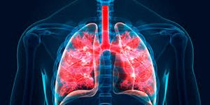 TIPS PARA MEJORAR TU CALIDAD DE VIDA | BRONQUITIS 1 - Esta enfermedad es tan común que cualquier infección respiratoria, incluso resfriado o faringitis (inflamación de garganta) puede desatarla, pues los mismos agentes que provocan...