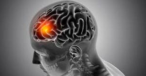 TIPS PARA MEJORAR TU CALIDAD DE VIDA | UN ICTUS - Un ictus, también conocido como accidente cerebrovascular (ACV) o ataque cerebral, ocurre cuando se interrumpe el flujo sanguíneo a una parte del cerebro, ya sea por un bloqueo...
