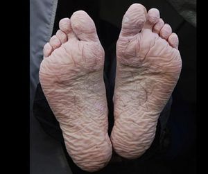 ¡ALERTA IMSS POR PIE TRINCHERA!