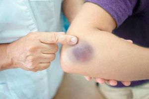 TIPS  PARA MEJORAR TU CALIDAD DE VIDA | LOS MORETONES 1 - Usted no recuerda haberse golpeado con algo, pero percibe otra marca azul en su brazo, comúnmente conocido como moretón (también denominado…