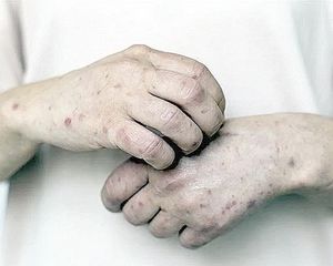 ¡REGISTRA TODO MÉXICO BROTES DE SARAMPIÓN!