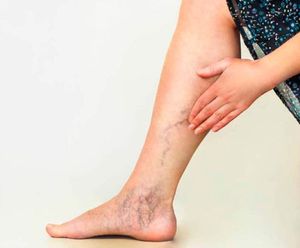 TIPS PARA MEJORAR LA CALIDAD DE VIDA | VARICES - Las varices, también conocidas como venas varicosas, son venas dilatadas que se hinchan y se retuercen, generalmente visibles bajo la piel, y a menudo aparecen en las piernas...