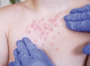 ¡REGISTRA MÉXICO MÁS DE 9 MIL CASOS DE SARAMPIÓN!