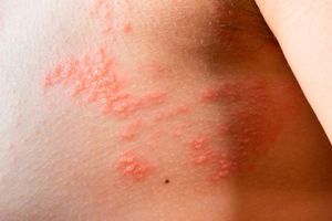 TIPS PARA MEJORAR TU CALIDAD DE VIDA | LA SARNA 2 - Continuamos con el tema de la sarna y te puedo decir que con el paso del tiempo, los surcos pueden resultar difíciles de ver, ya que quedan enmascarados por la inflamación producida por el rascado…