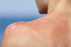¿CUÁLES SON LOS RIESGOS DE LA EXPOSICIÓN AL SOL?