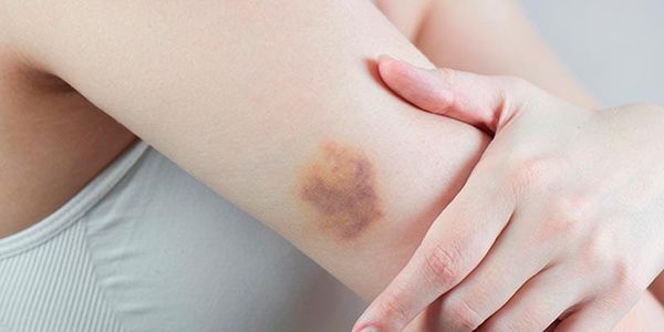 TIPS PARA MEJORAR TU CALIDAD DE VIDA | LOS MORETONES - Usted no recuerda haberse golpeado con algo, pero percibe otra marca azul en su brazo, comúnmente conocido como moretón (también denominado equimosis o cardenal).